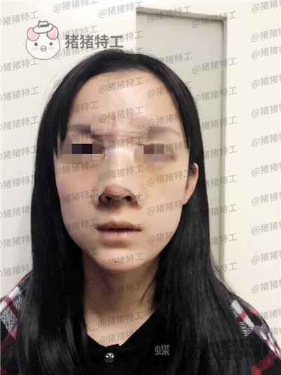成都西区医院车红昌隆鼻案例价格分享,亲戚都说我鼻子高高的很好看~