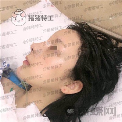 成都西区医院车红昌隆鼻案例价格分享,亲戚都说我鼻子高高的很好看~
