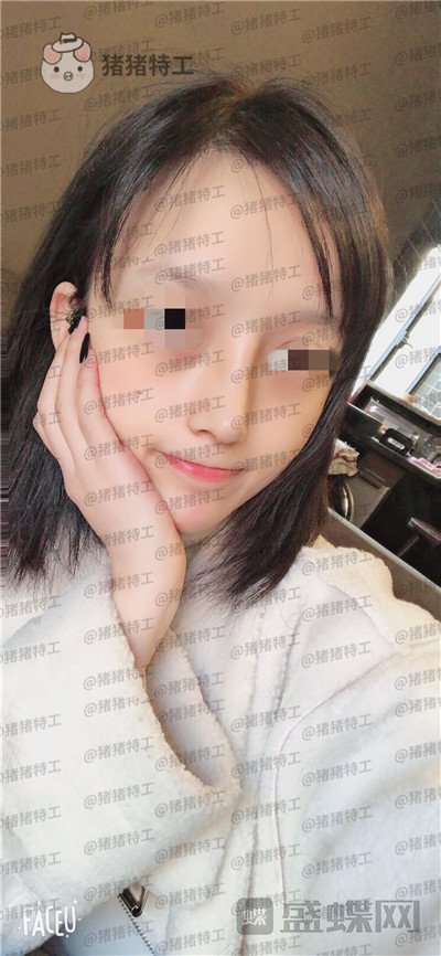 成都西区医院车红昌隆鼻案例价格分享,亲戚都说我鼻子高高的很好看~