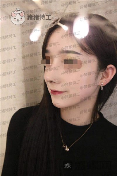 成都西区医院车红昌隆鼻案例价格分享,亲戚都说我鼻子高高的很好看~
