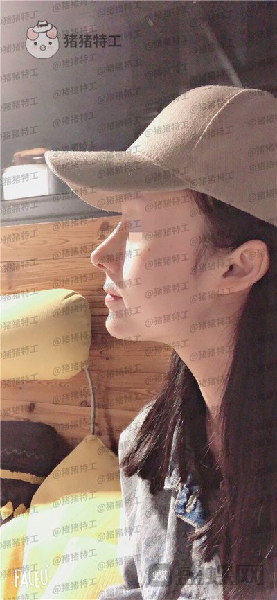 成都西区医院车红昌隆鼻案例价格分享,亲戚都说我鼻子高高的很好看~
