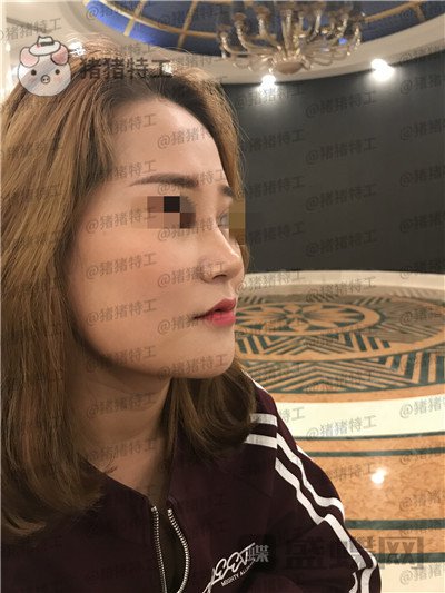 北京玲珑梵宫张燕雄隆鼻案例价格分享,货比三家找到的良心医院成果太完美了~