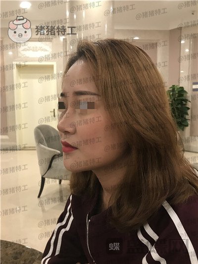 北京玲珑梵宫张燕雄隆鼻案例价格分享,货比三家找到的良心医院成果太完美了~