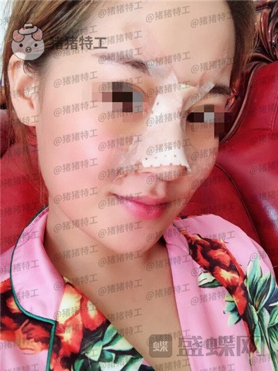 北京玲珑梵宫张燕雄隆鼻案例价格分享,货比三家找到的良心医院成果太完美了~