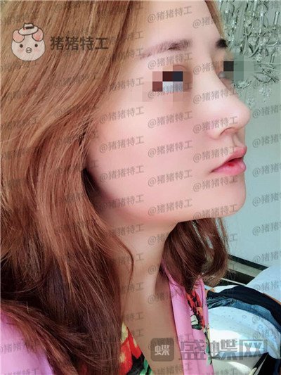 北京玲珑梵宫张燕雄隆鼻案例价格分享,货比三家找到的良心医院成果太完美了~