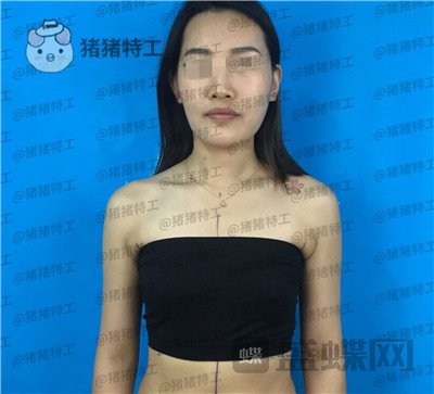 郑州集美赵亮隆胸案例价格分享,谁说模特一定要平胸?