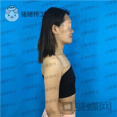郑州集美赵亮隆胸案例价格分享,谁说模特一定要平胸?