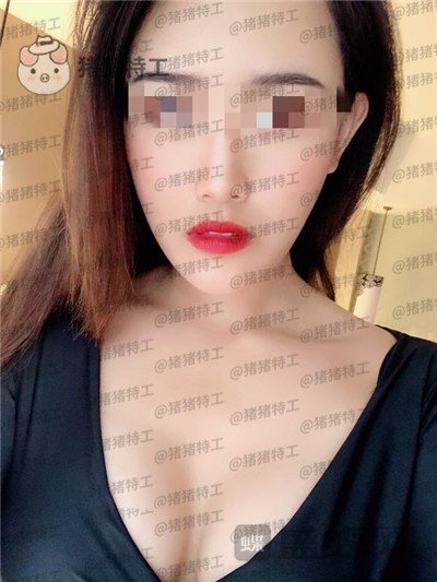 郑州集美赵亮隆胸案例价格分享,谁说模特一定要平胸?