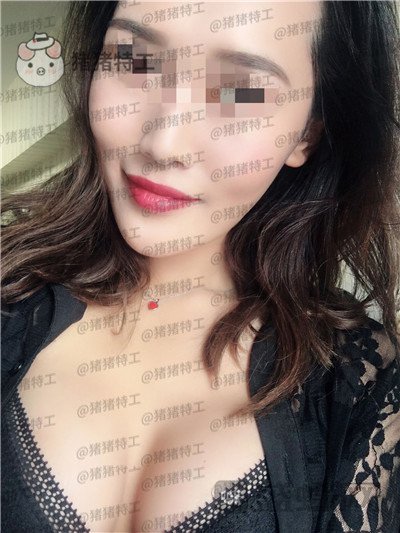 郑州集美赵亮隆胸案例价格分享,谁说模特一定要平胸?
