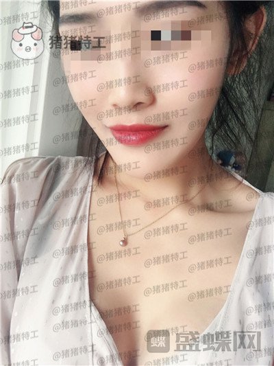 郑州集美赵亮隆胸案例价格分享,谁说模特一定要平胸?