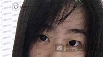 昆明悦格陈玉琼双眼皮案例价格分享,泰国的同学们都问我在哪里做的。