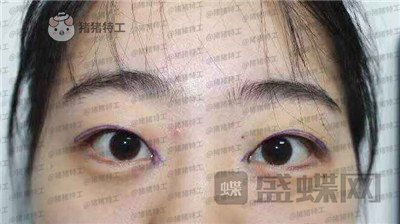 昆明悦格陈玉琼双眼皮案例价格分享,泰国的同学们都问我在哪里做的。