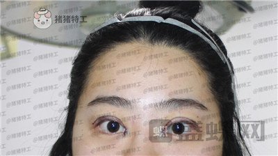 昆明悦格陈玉琼双眼皮案例价格分享,泰国的同学们都问我在哪里做的。