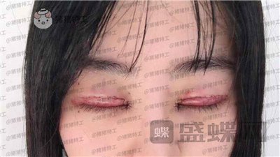 昆明悦格陈玉琼双眼皮案例价格分享,泰国的同学们都问我在哪里做的。