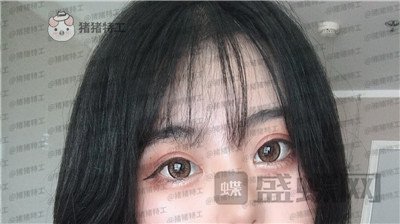 昆明悦格陈玉琼双眼皮案例价格分享,泰国的同学们都问我在哪里做的。