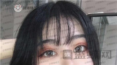 昆明悦格陈玉琼双眼皮案例价格分享,泰国的同学们都问我在哪里做的。
