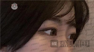 昆明悦格陈玉琼双眼皮案例价格分享,泰国的同学们都问我在哪里做的。