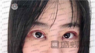 昆明悦格陈玉琼双眼皮案例价格分享,泰国的同学们都问我在哪里做的。