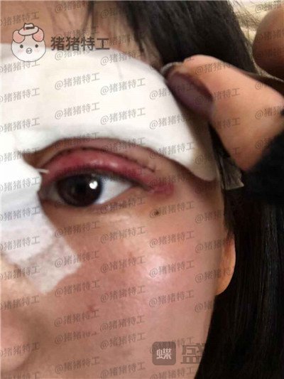昆明悦格陈玉琼双眼皮案例价格分享,泰国的同学们都问我在哪里做的。