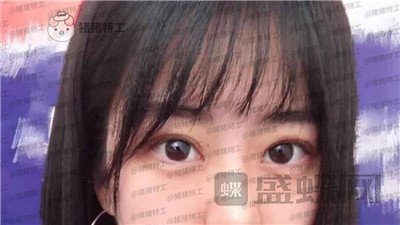 昆明悦格陈玉琼双眼皮案例价格分享,泰国的同学们都问我在哪里做的。
