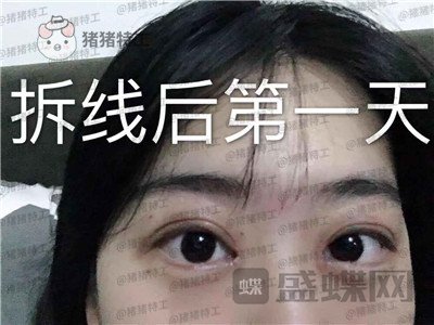 昆明悦格陈玉琼双眼皮案例价格分享,泰国的同学们都问我在哪里做的。
