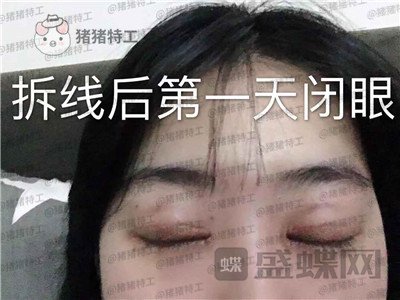 昆明悦格陈玉琼双眼皮案例价格分享,泰国的同学们都问我在哪里做的。