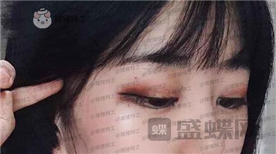 昆明悦格陈玉琼双眼皮案例价格分享,泰国的同学们都问我在哪里做的。