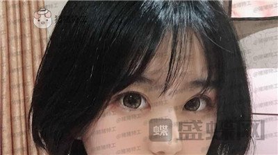 昆明悦格陈玉琼双眼皮案例价格分享,泰国的同学们都问我在哪里做的。