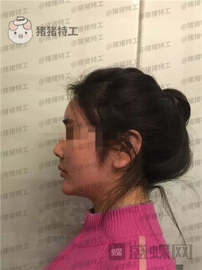 重庆姚明君吸脂去双下巴案例价格分享,有轮廓感的脸瞬间显年轻了。