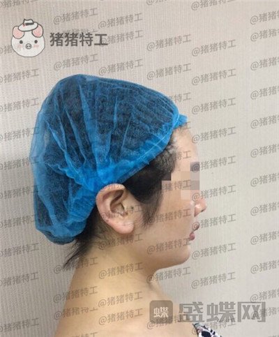 重庆姚明君吸脂去双下巴案例价格分享,有轮廓感的脸瞬间显年轻了。