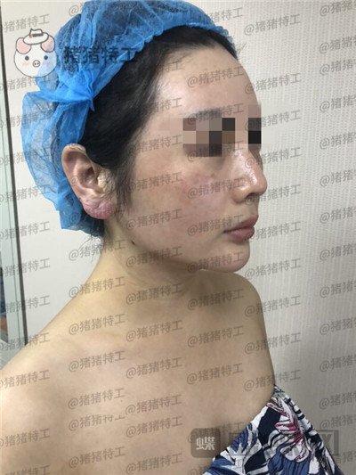 重庆姚明君吸脂去双下巴案例价格分享,有轮廓感的脸瞬间显年轻了。