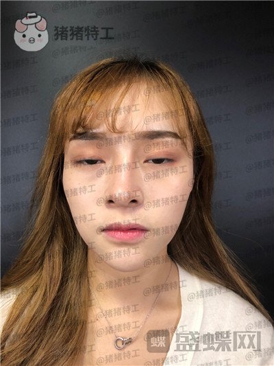 长沙艺星陈明松鼻修复案例价格分享,鼻子歪了是医生拯救了我~