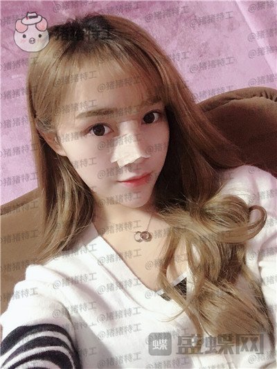 长沙艺星陈明松鼻修复案例价格分享,鼻子歪了是医生拯救了我~