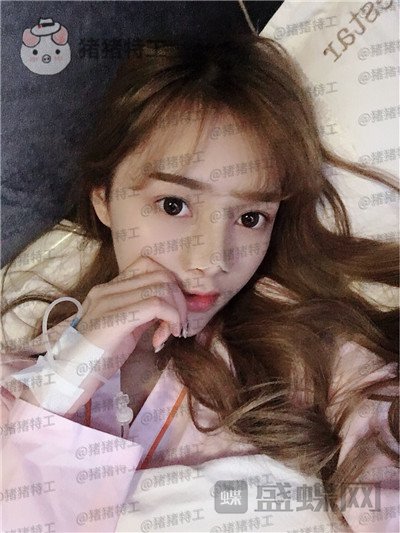 长沙艺星陈明松鼻修复案例价格分享,鼻子歪了是医生拯救了我~