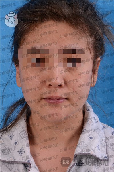 北京美莱宋延刚面部填充案例价格分享,直接年轻十五岁的果太惊艳了!