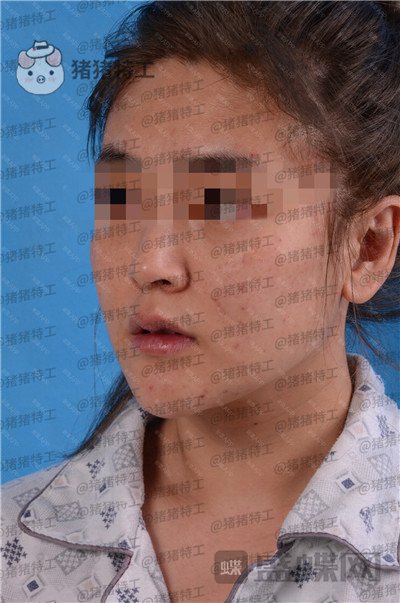 北京美莱宋延刚面部填充案例价格分享,直接年轻十五岁的果太惊艳了!