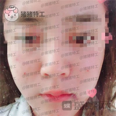 北京美莱宋延刚面部填充案例价格分享,直接年轻十五岁的果太惊艳了!