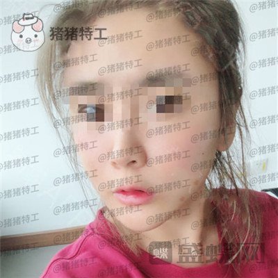 北京美莱宋延刚面部填充案例价格分享,直接年轻十五岁的果太惊艳了!