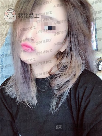 北京美莱宋延刚面部填充案例价格分享,直接年轻十五岁的果太惊艳了!
