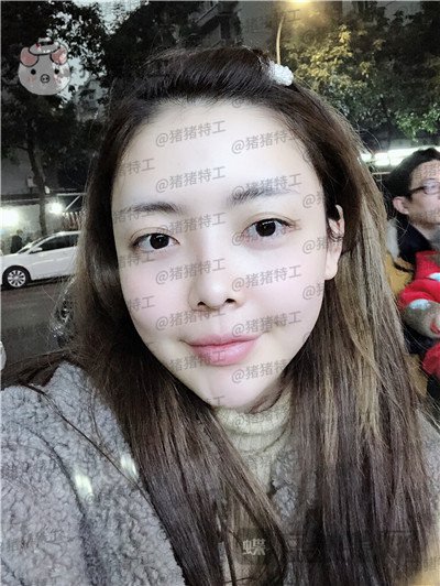 重庆华美潘宝华颧骨整形案例价格分享,神仙颜值先鬼后人的蜕变。