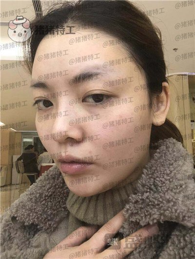 重庆华美潘宝华颧骨整形案例价格分享,神仙颜值先鬼后人的蜕变。