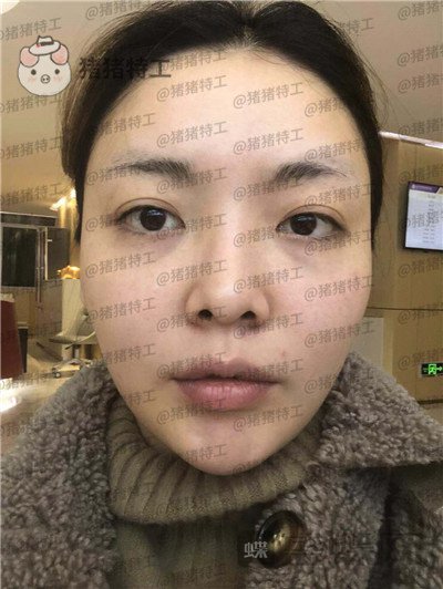 重庆华美潘宝华颧骨整形案例价格分享,神仙颜值先鬼后人的蜕变。