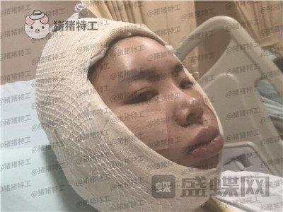 重庆华美潘宝华颧骨整形案例价格分享,神仙颜值先鬼后人的蜕变。