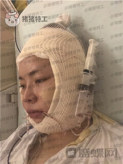 重庆华美潘宝华颧骨整形案例价格分享,神仙颜值先鬼后人的蜕变。