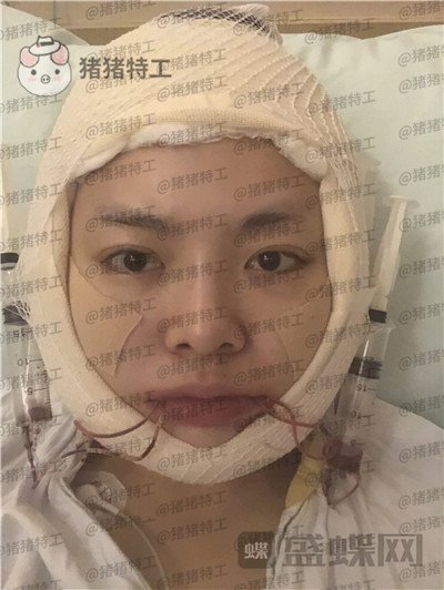 重庆华美潘宝华颧骨整形案例价格分享,神仙颜值先鬼后人的蜕变。