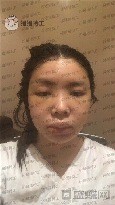 重庆华美潘宝华颧骨整形案例价格分享,神仙颜值先鬼后人的蜕变。