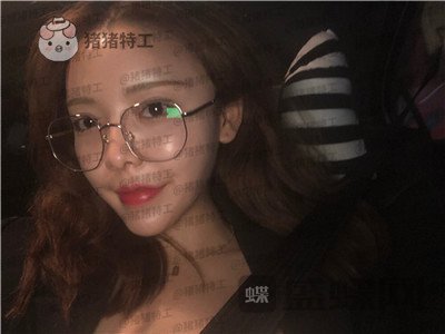 重庆华美潘宝华颧骨整形案例价格分享,神仙颜值先鬼后人的蜕变。