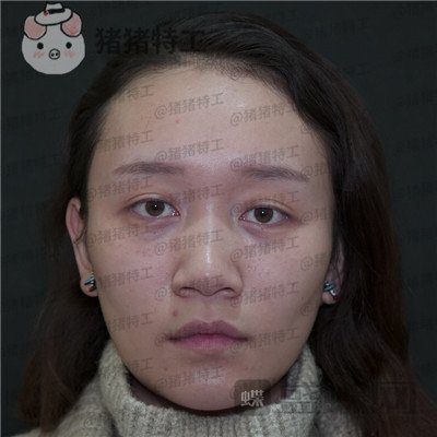 贵阳华美黄在弘面部填充案例价格分享,做这么多项目的果大家觉得好看吗?