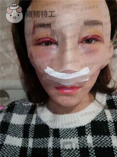 贵阳华美黄在弘面部填充案例价格分享,做这么多项目的果大家觉得好看吗?