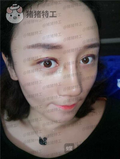 贵阳华美黄在弘面部填充案例价格分享,做这么多项目的果大家觉得好看吗?
